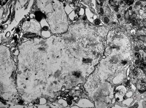 F,58y. | Whipple disease F,58y. | Whipple disease